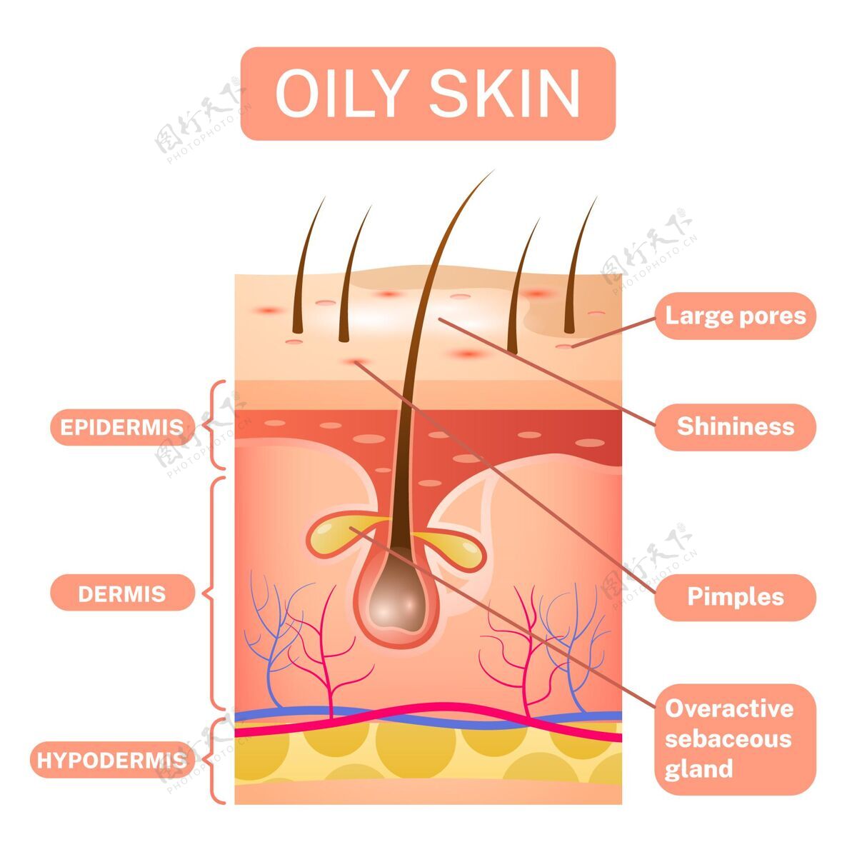 油性皮肤真实的油性皮肤层插图问题问题皮肤护理